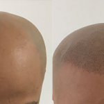 scalp micro pigmentation Zang SMP