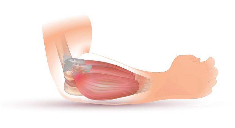 Tennis Elbow: Causes, Symptoms, and Treatments