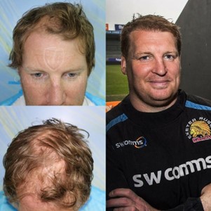 5000 Grafts Hair Transplant 