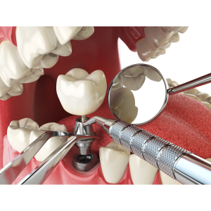 Dental Impants
